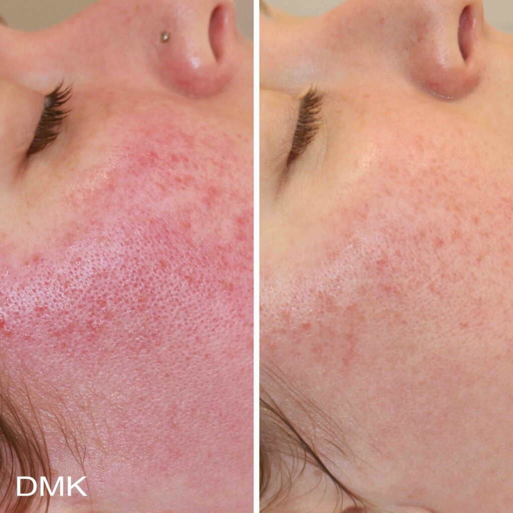 rosacea_3